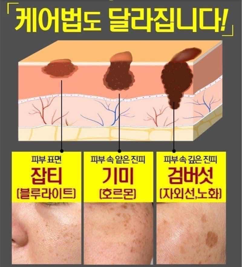 Melanon cream ជាំ​អាចម៍រុយ​យូរឆ្នាំ​