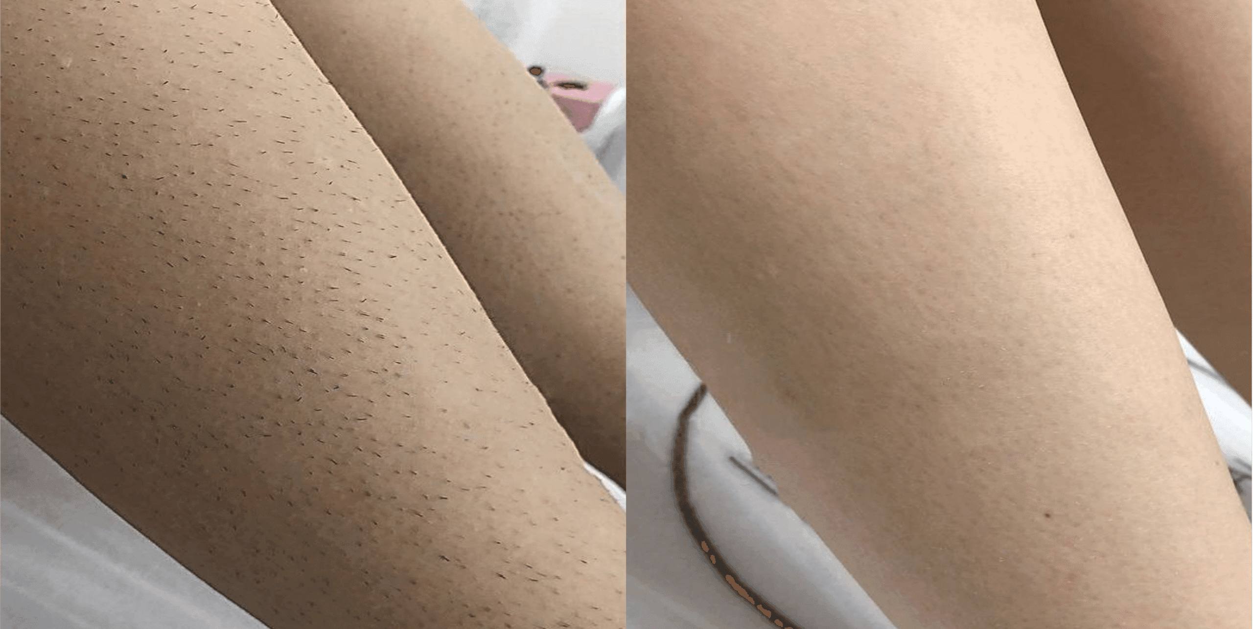 Laserជម្រុះរោមជេីង