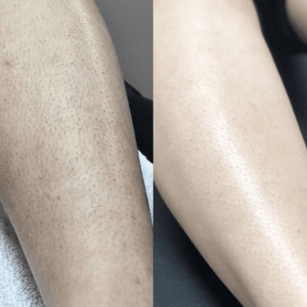 Laserជម្រុះរោមជេីង