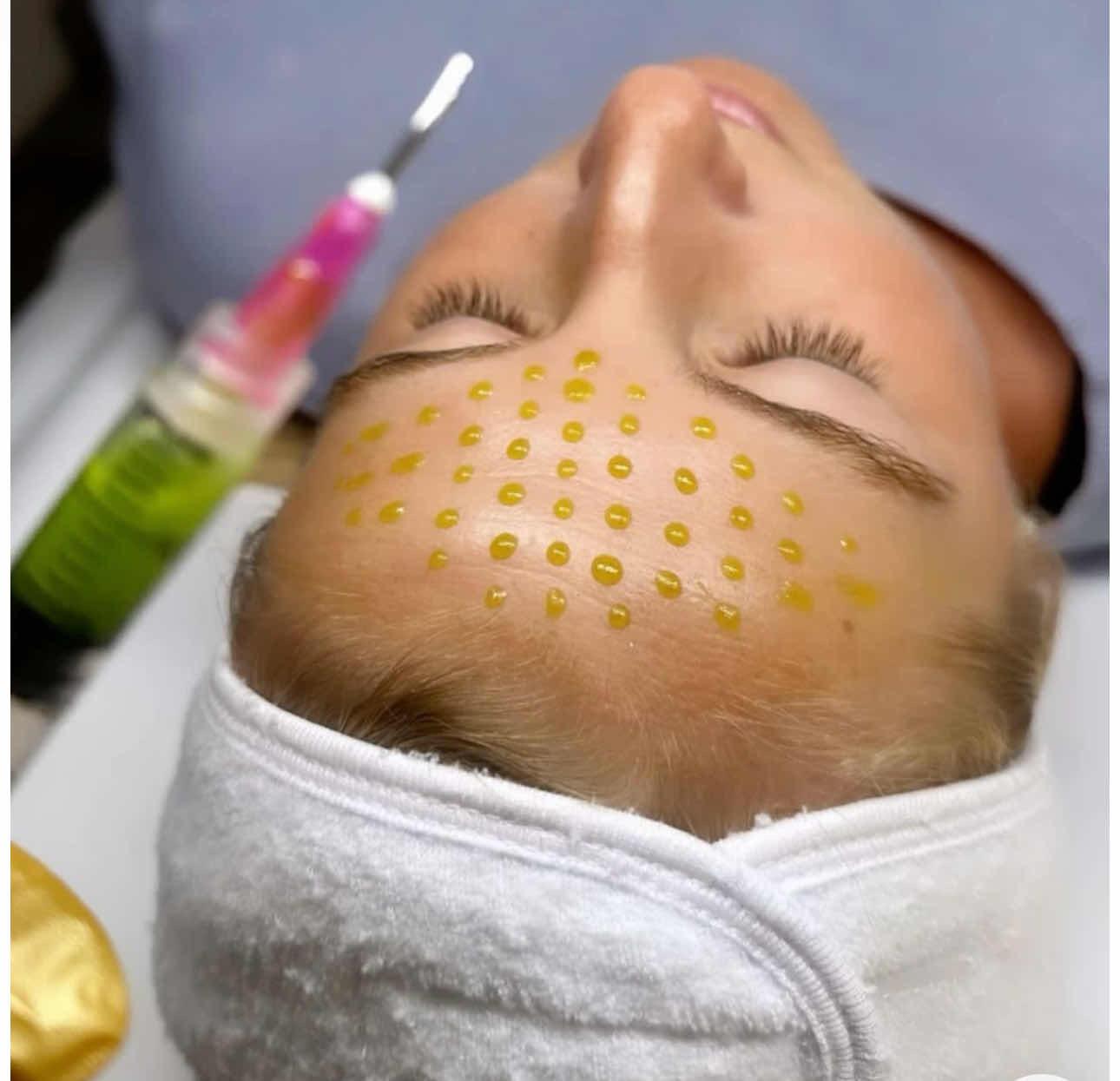 ដើរម្ជុលទាលមុខតឹង /  peeling tightening