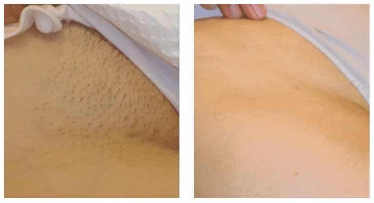 Laserប៊ីគីនី 
