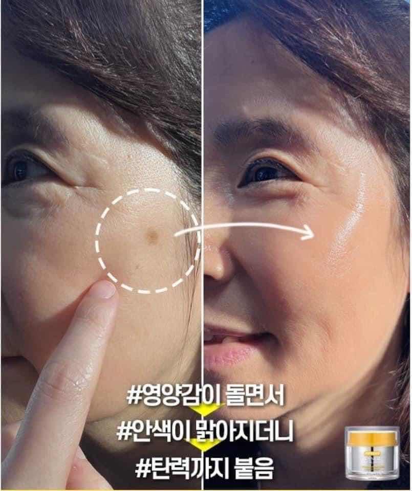 Melanon cream ជាំ​អាចម៍រុយ​យូរឆ្នាំ​