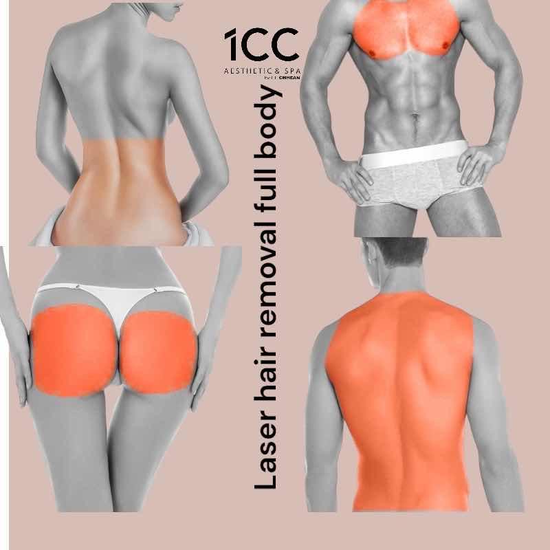 ជំរុះរោម1តួខ្លួន / Laser hair removal full body