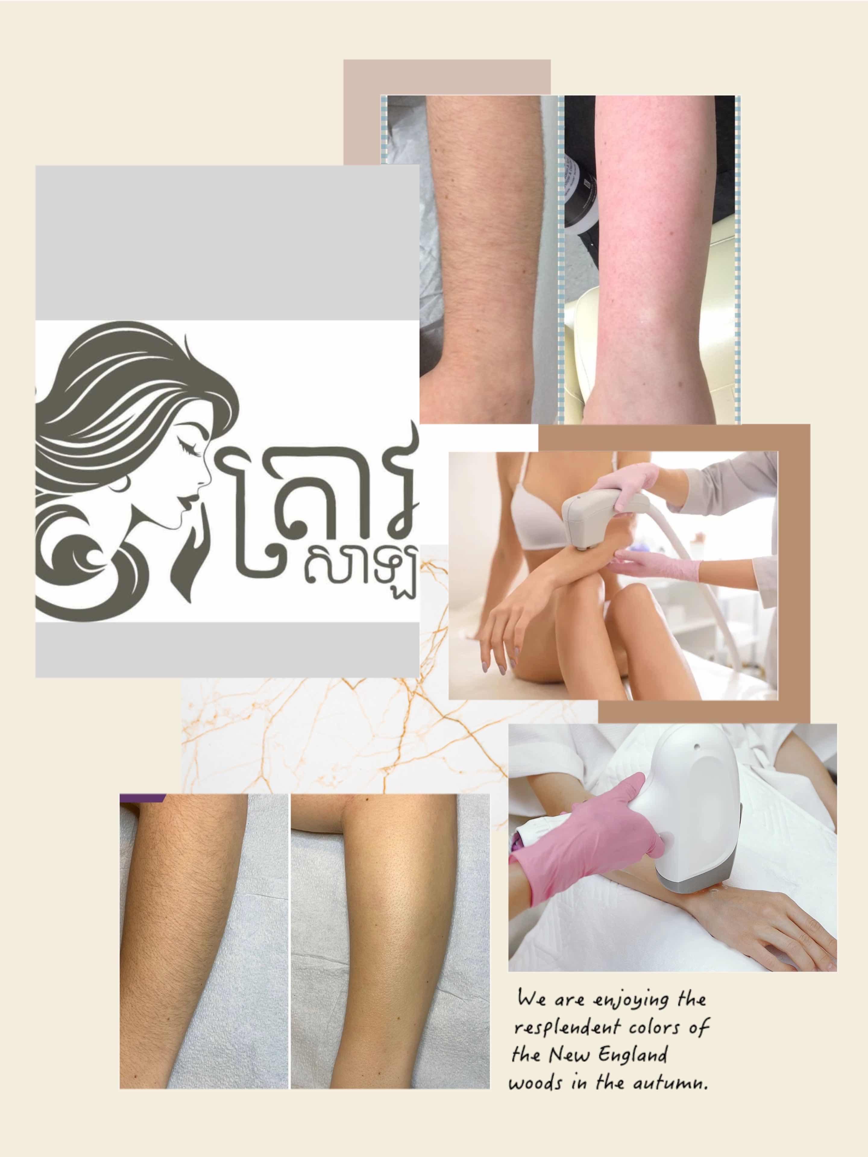 Laserជម្រុះរោម ដៃ