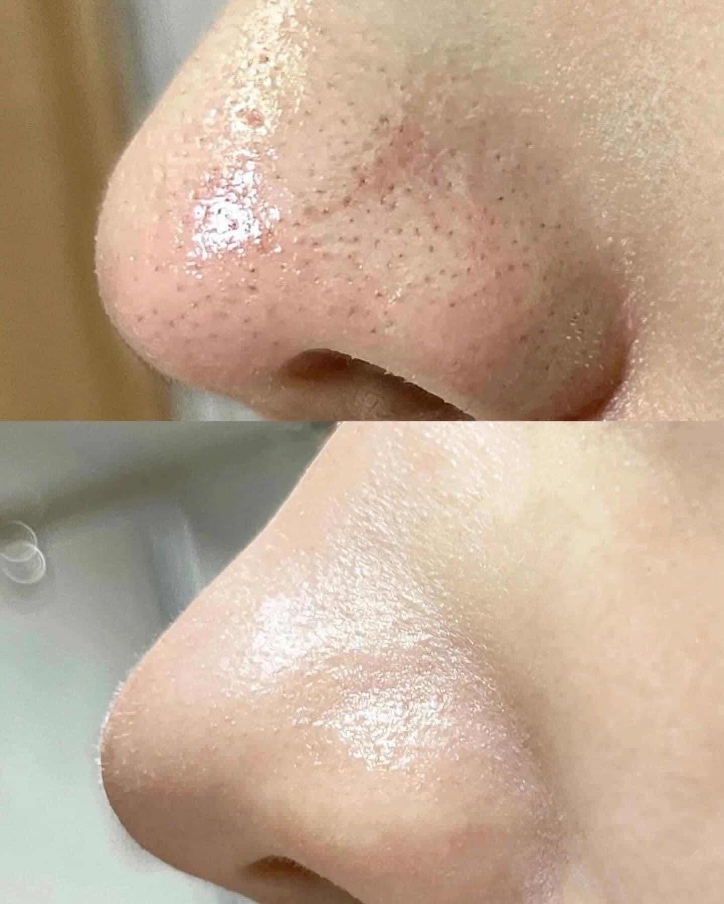 Nose Patch