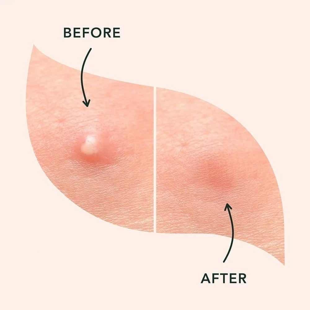 Pimple Patches for Face