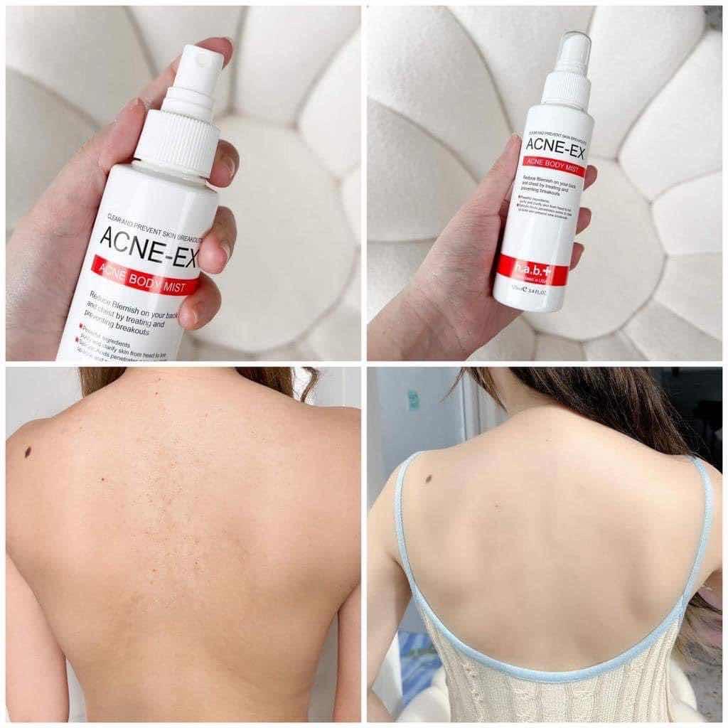Acne Ex Body Mist - Back Spray 