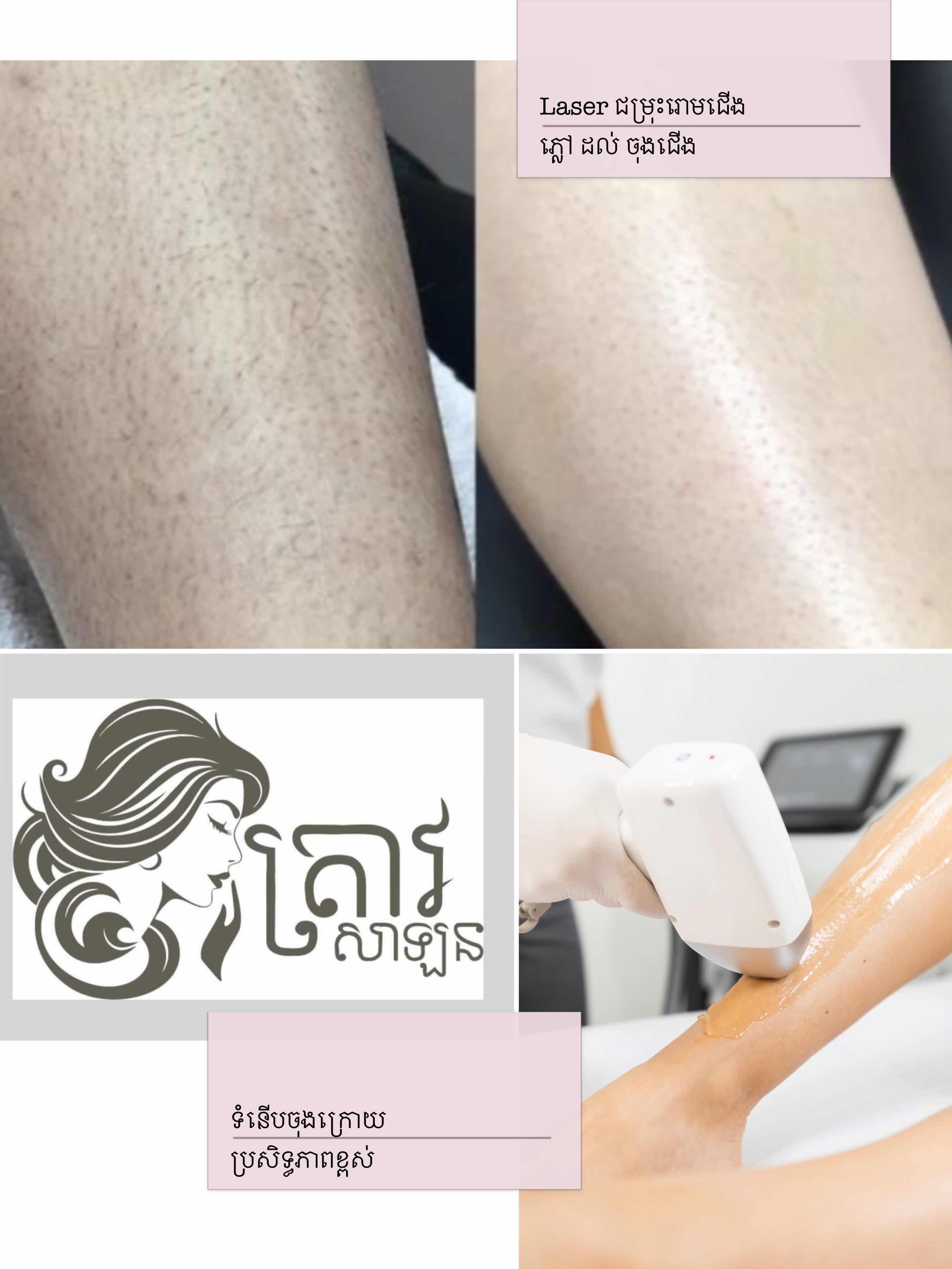 Laserជម្រុះរោមជេីង