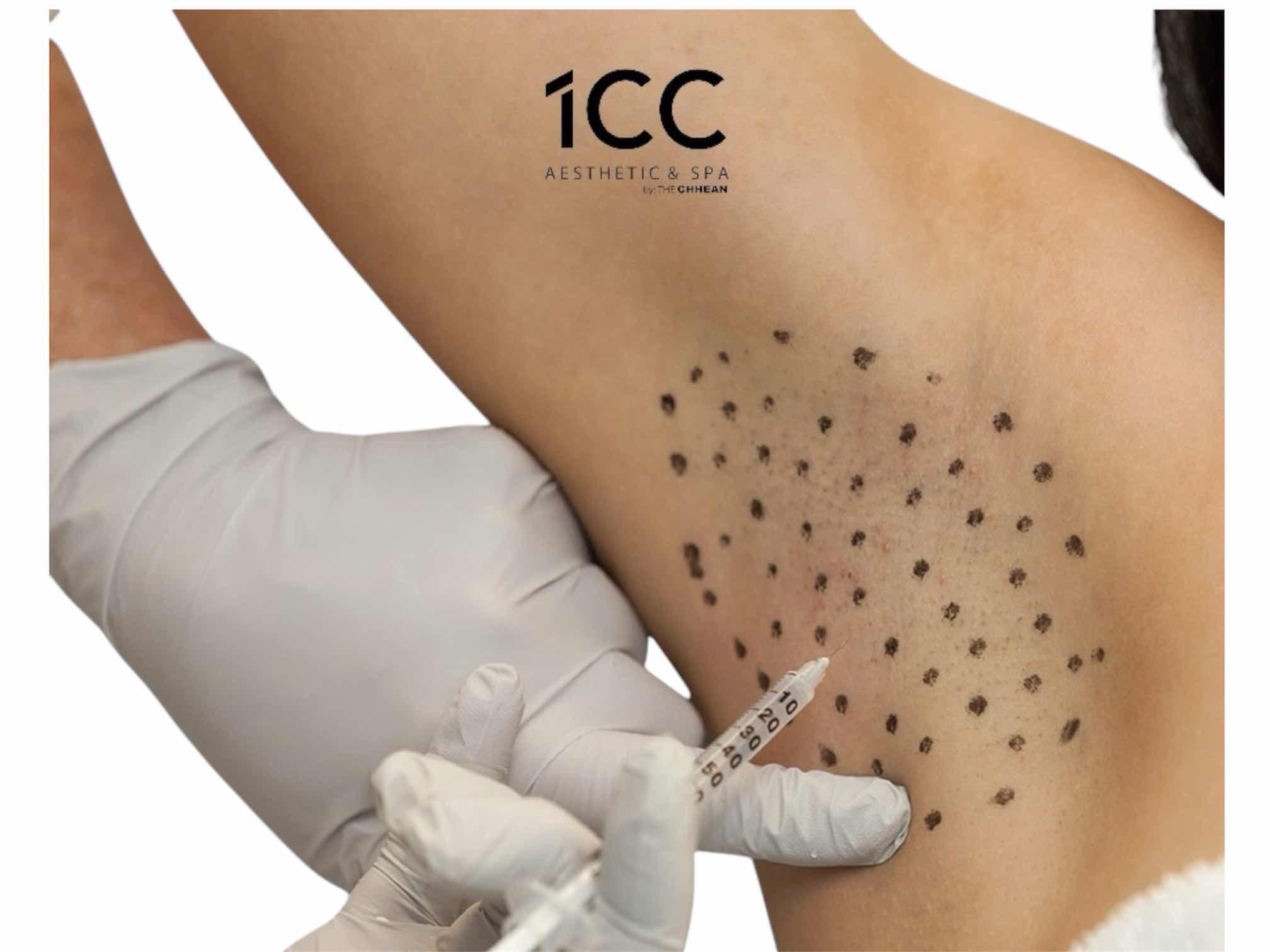 ចាក់បំបាត់បែកញើស/ Botox armpit