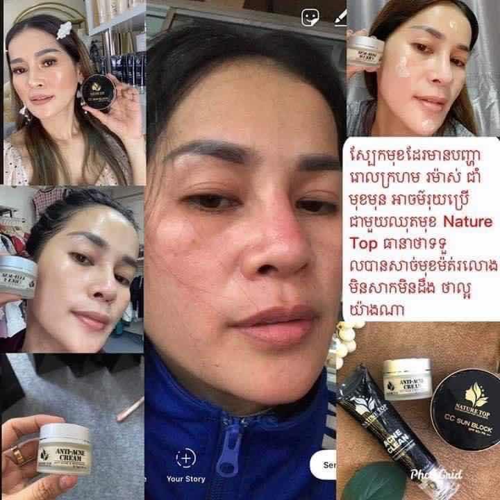 Anti -Acne Cream & whitening